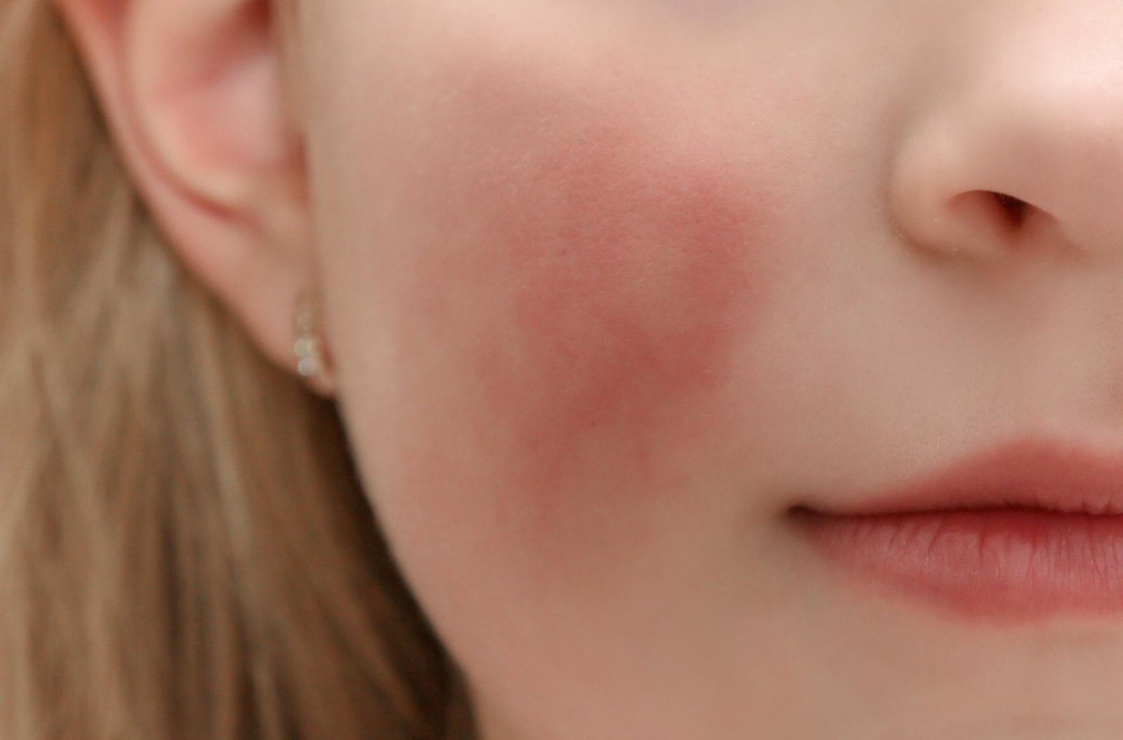 Skin Problem